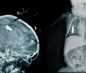 X rays of children with bullet and shrapnel injuries